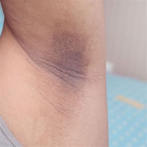 Axilas Escuras O Que Pode Ser - Clareia axila: Receitinha extermina manchas escuras do corpo
