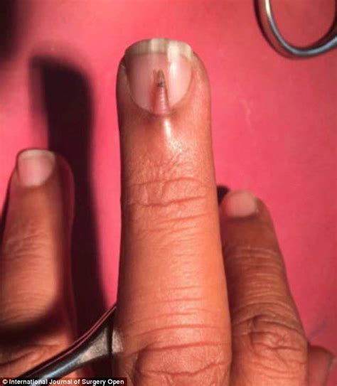 Pakistani man, 28, has another small nail growing on top of his ...