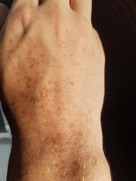 Dark Spots On Back Of Arm at James Earle blog