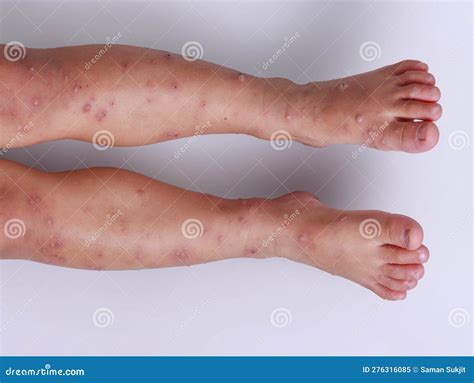 Hand Foot And Mouth Disease On Legs