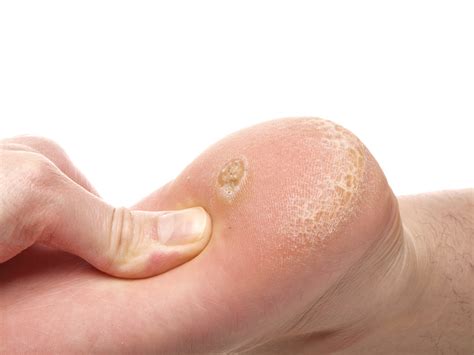 Plantar warts: some tips to treat them! – CLINIQUE PODIATRIQUE