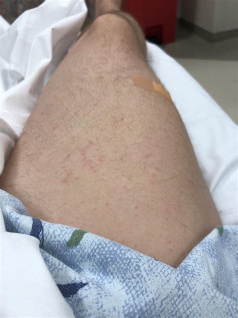 Rash after being glutened. Started getting to the point of needing to