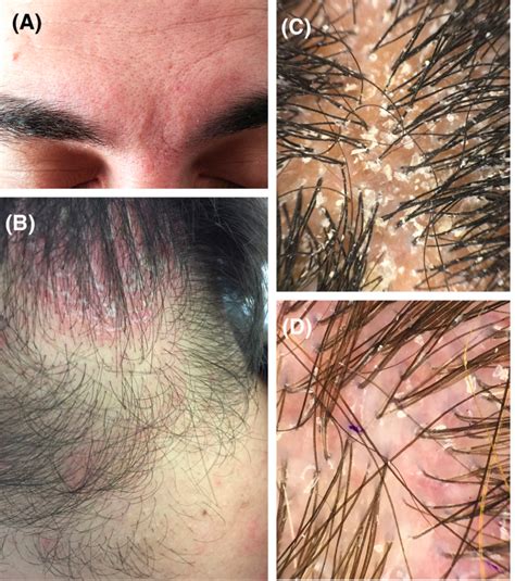 What Causes Folliculitis Ps On Scalp - Infoupdate.org