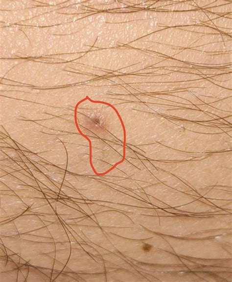 Ingrown hair?? : r/DiagnoseMe