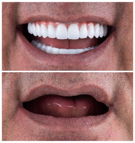 Full Set of New Teeth Turkey: Full-Mouth Dental Implant Cost