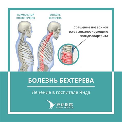 Болезнь Бехтерева • Yanda Hospital | Hospital