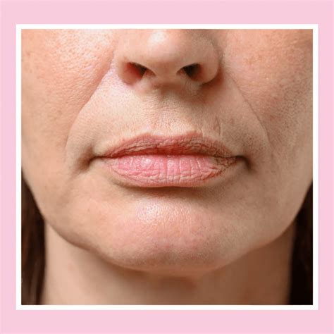 Jowls Treatment in London | Lift and Firm Your Jowls