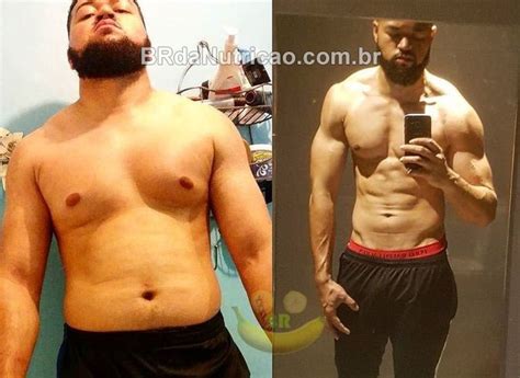 Lipomastia Antes E Depois - Lipomastia LP — BR da Nutrição | Nutricionistas Consultoria Fitness Online