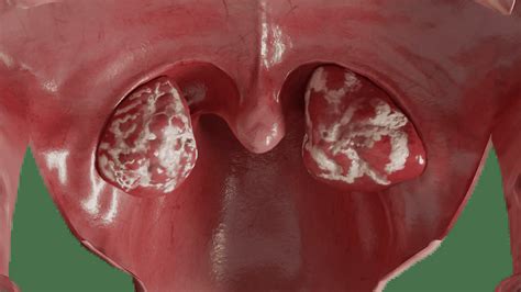 3D Model of Acute Tonsillitis | VOKA