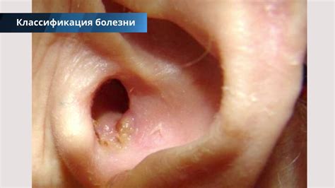 Как выглядит ушной грибок у человека фото