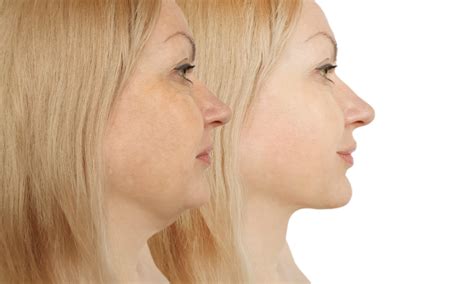 cheek enhancement solihull urban body aesthetics