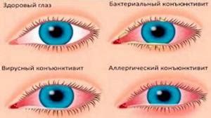 Как передается конъюнктивит - Офтальмология