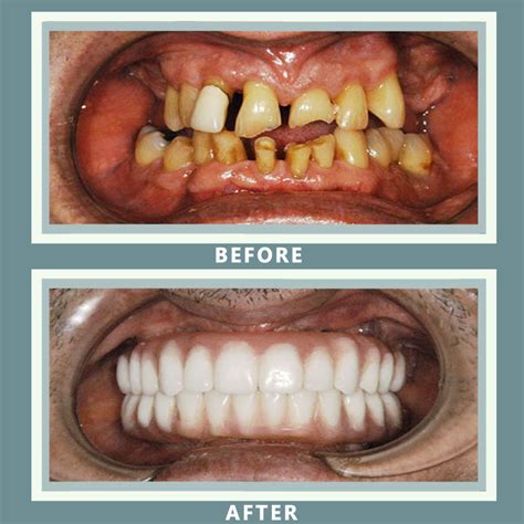 Dental Implant Before And After