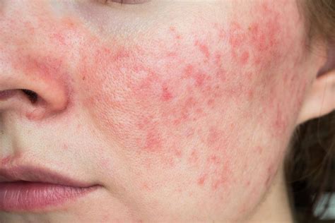 facial rash    calm