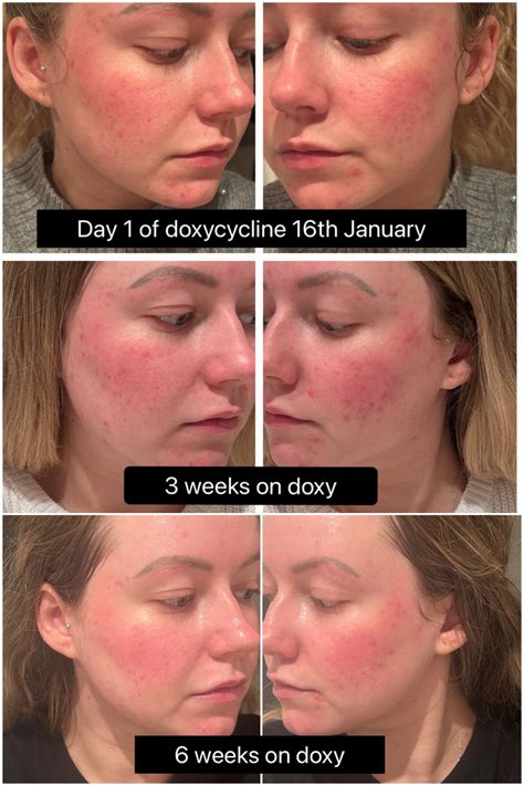 Win or loss? Can’t decide : r/Rosacea
