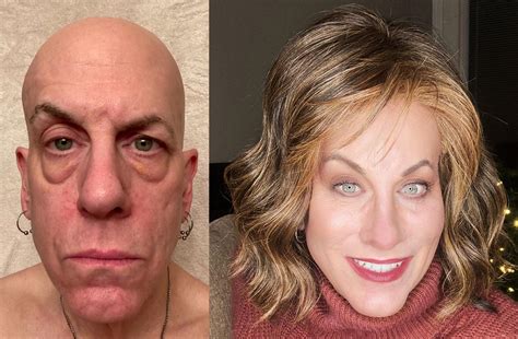 65 MTF, 21 Months HRT, Partial FFS, Year End Recap!! : r/transtimelines