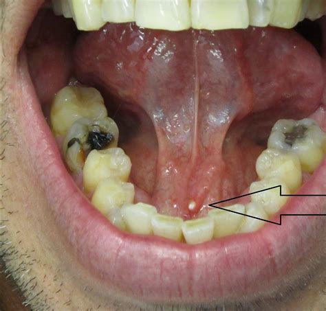 What Is Saliva Stones at Shirley Pierson blog