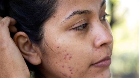how long does pimple scars take to heal