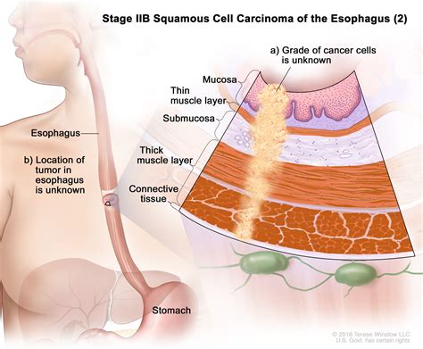 Esophageal Cancer Treatment - NCI