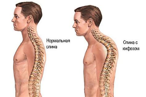 Кифоз грудного отдела позвоночника – симптомы и лечение