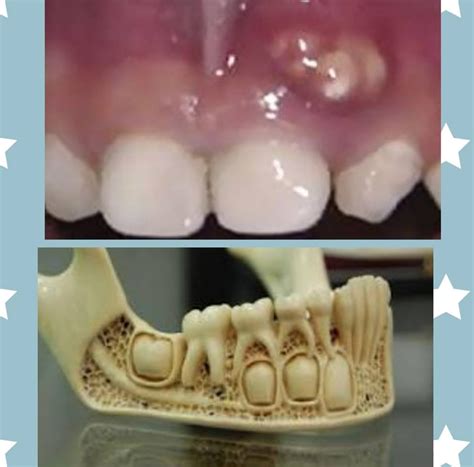 Como Saber Se O Dente É De Leite - Dente de Leite tem raíz?