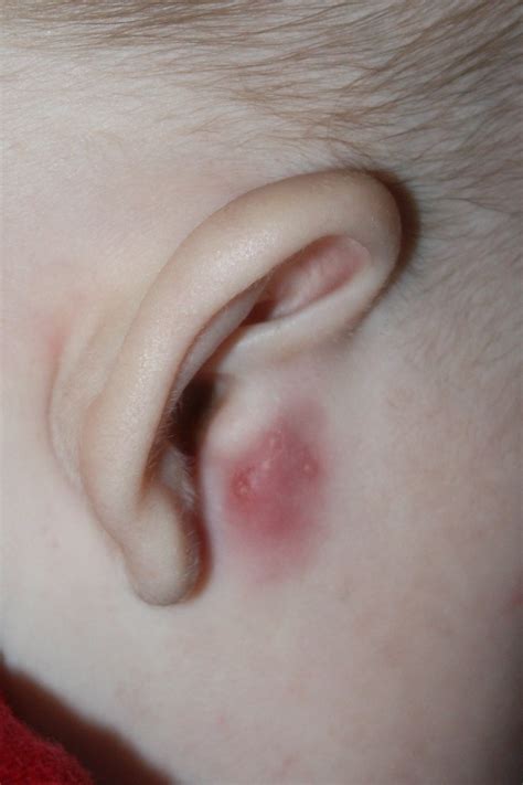 Swollen lymph nodes behind ear - kizacreative