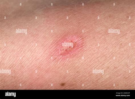 how to know if a spider bite is infected