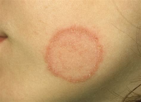 Red Scaly Rash: the papulosquamous eruption Flashcards | Quizlet