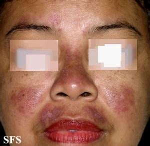 How To Diagnose Lupus (SLE)? Symptoms and Tests - Healthhype