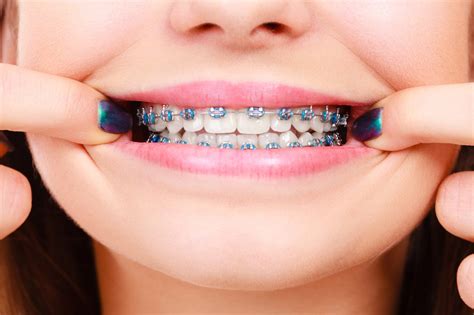Colorful Braces