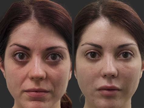 Smile Line Filler Before and After – Filler Aesthetic
