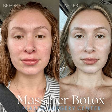 masseter botox gallery    newbeauty