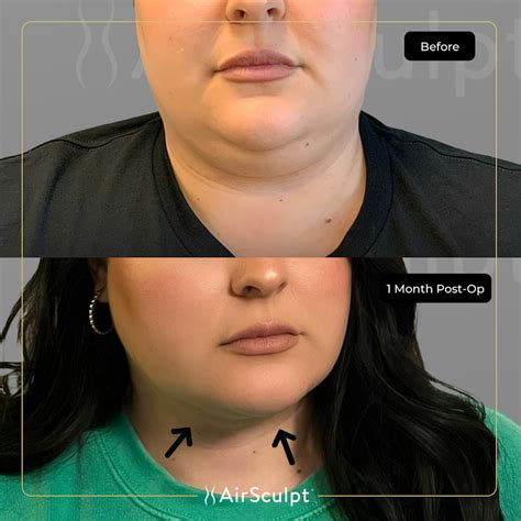 See What Double Chin Removal With AirSculpt® Achieved in Just One Month