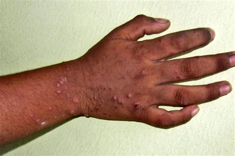hand foot  mouth disease hfmd  comprehensive guide