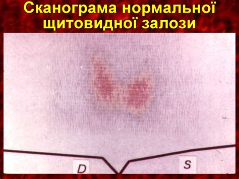 Захворювання щитоподібної залози - презентация онлайн