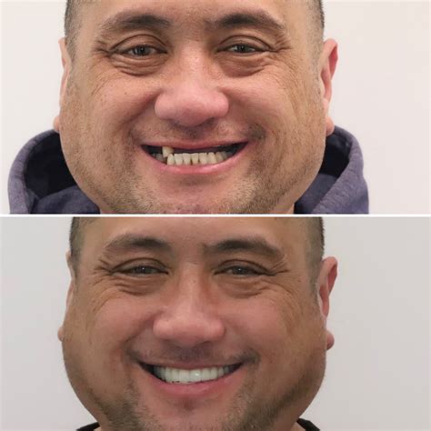 Geelong Implant Institute | Official ALL-ON-4® Centre Of Excellence