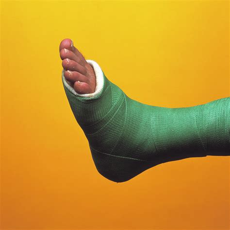 Broken Foot Photograph by Alex Bartel/science Photo Library | Pixels