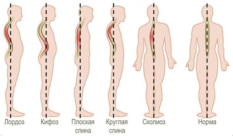 Правильные упражнения при сколиозе для 1, 2, 3 степени | Массаж.ру