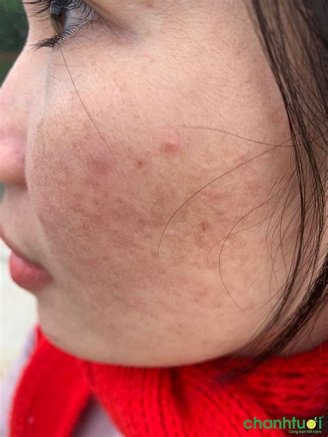 Review dùng Retinol Obagi 1% cho da dầu sau 3 tháng sử dụng