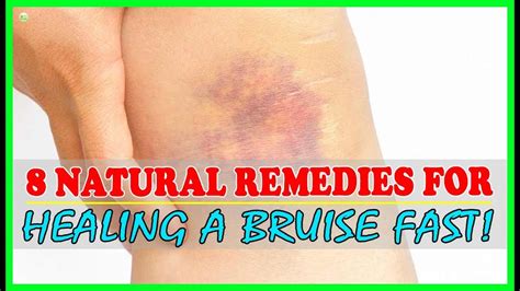 How To Get Rid Of Bruises Fast And Naturally? - Bruise Treatment | Best ...