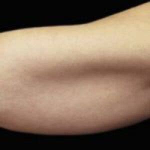 Before & After Upper Arms Procedures in Santa Monica | Self Care LA