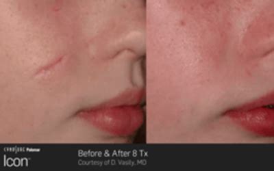 surgical scars maynooth medical skin  laser