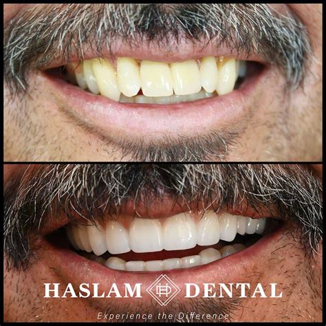Smile Gallery - Haslam Dental's Patient Transformations