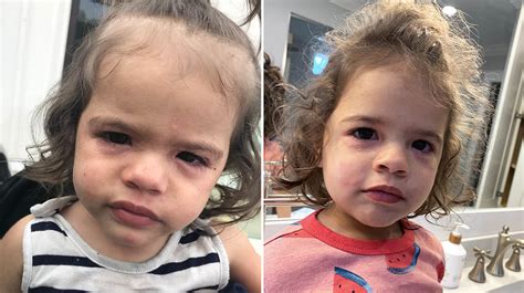 Alergia A Amendoim Fotos - Alergia ao amendoim: sintomas e tratamento - Tua Saúde
