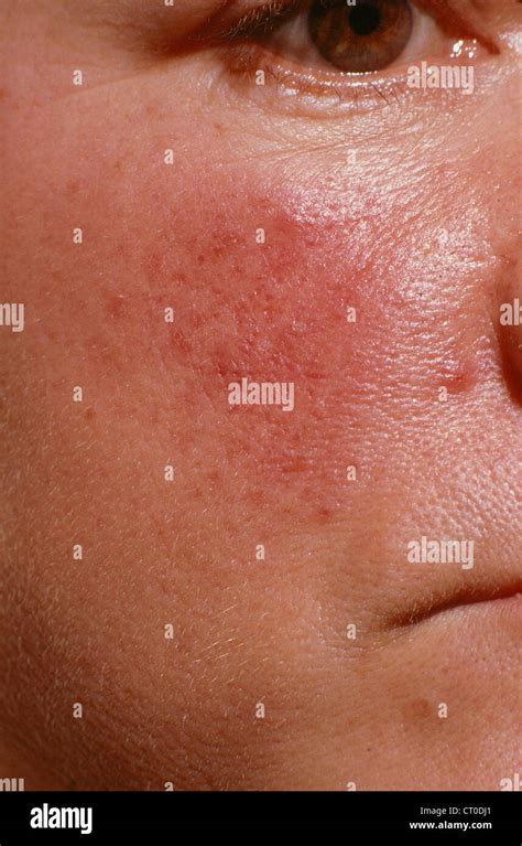 ACNE ROSACEA Stock Photo - Alamy