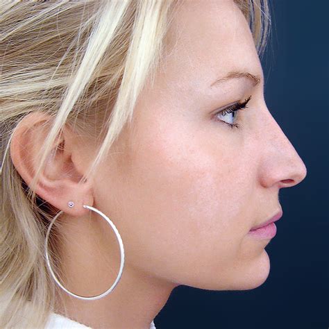 Rhinoplastika | Klinika Esthé Praha