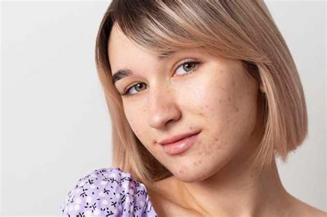 Как убрать рубцы от прыщей на лице
