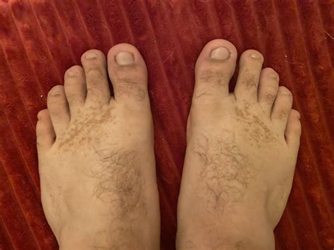 What is going on with the dark spots on my feet? : r/medical