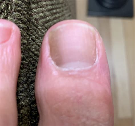 Worried that dark area on big toe is cancer : r/Dermatology