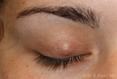 Chalazion (cyst): Symptoms, Pictures, Causes, And Treatment, 55% OFF